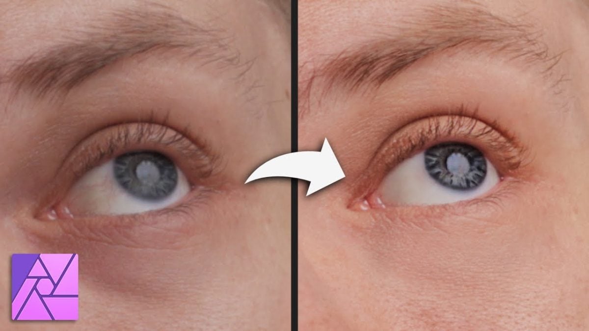 lazy eye affinity